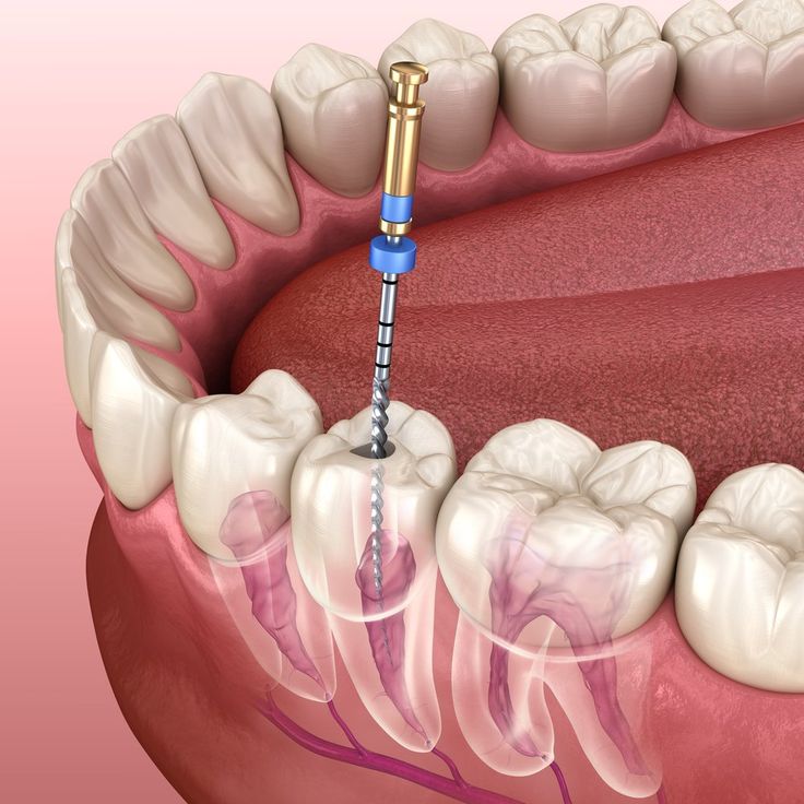 what you need to know before your root canal procedure